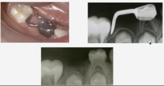 <p>Primary dentition only</p><p>Unilateral distal shoe space maintainer</p>