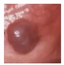 <p>-angio is blood vessel, sarcoma is a tumor of the mesenchyme; it is a tumor of the vessels and lymph channels</p><p>-purple nodule/plaque</p><p>-bad</p><p>-breast(radiation), liver(vinyl chloride exposure), beneath the skin around head and neck(sun exposure)</p><p>-from the dermis(this is where blood vessels are!)</p>