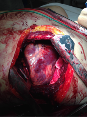 <p>May be performed only under certain situations</p><p>- Relief of large pericardial effusion</p><p>- Direct control of exsanguinating intra-thoracic hemorrhage</p><p>- Open cardiac massage (manual CPR)</p><p>- Allows cross-clamping of aorta to increase perfusion to heart and brain</p><p>ED thoracotomy followed by OR exploration of wounds</p>