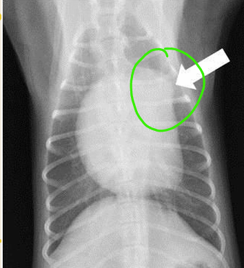 <p>Aortic stenosis</p>