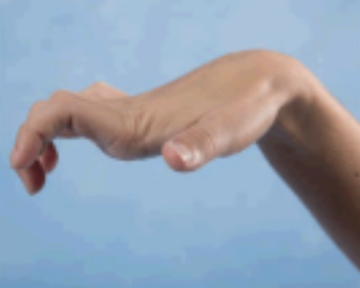 <p>Volkmann’s ischemic contracture</p>