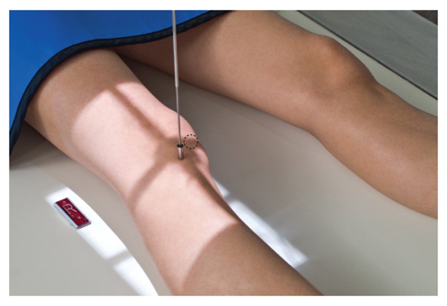 <p>S - on lap</p><p>T - 5 mAs @ 60 kVp</p><p>A - none</p><p>M - correct marker on cassette</p><p>P - PT supine w/ knee rotated 45 internally, CR 1/2" below patella</p><p>S - 40"</p><p>B - suspension</p><p>C - 10 x 12 lengthwise</p>