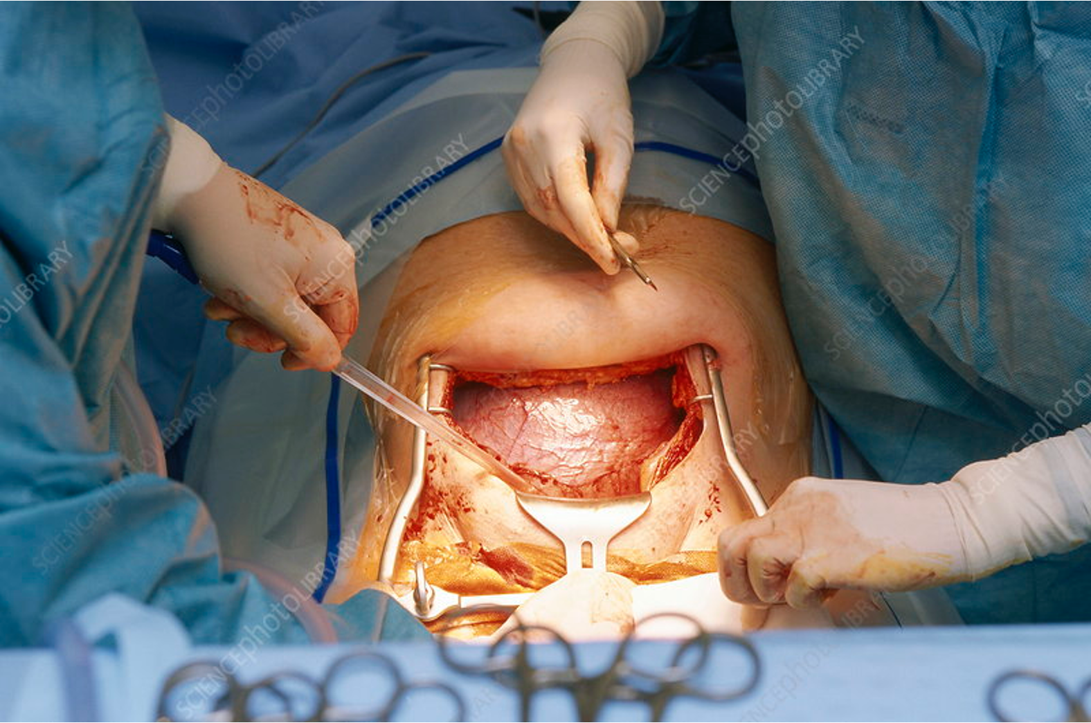 <ul><li><p><span><span>Identify the lower uterine segment</span></span></p></li><li><p><span><span>Bladder blade is inserted</span></span></p><ul><li><p><span><span>Create bladder flap (depends on surgeon)</span></span></p></li><li><p><span><span>Incise vesicouterine peritoneum</span></span></p></li><li><p><span><span>Push bladder down</span></span></p></li></ul></li></ul><p></p><p></p>