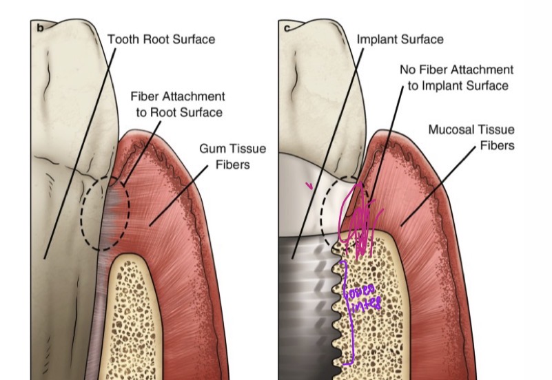 <p>Osseointegration</p><p>Establish peri implant mucosa- via JE and CT zone </p>