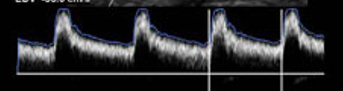<p>Based on the waveforms, Which vessel do they belong to?</p>