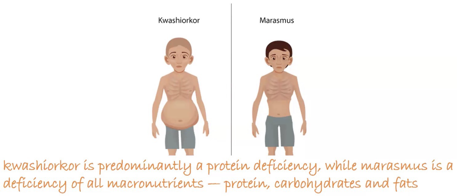 <p>Marasmus: Lack of all macronutrients; Excessive tissue/muscle wasting, little swelling/edema, loose skin</p><p>Kwashiorkor: Lack of protein intake; Irritability, big bellies, large liver, edemas/swelling due to osmotic imbalance</p>