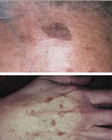 <p>A uniform demarcated brown color, may have irregular outline. Results in an increase in melanocytes, are benign brown macules. No color change with UV light</p>