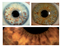 <p>What is the most likely diagnosis ?</p>