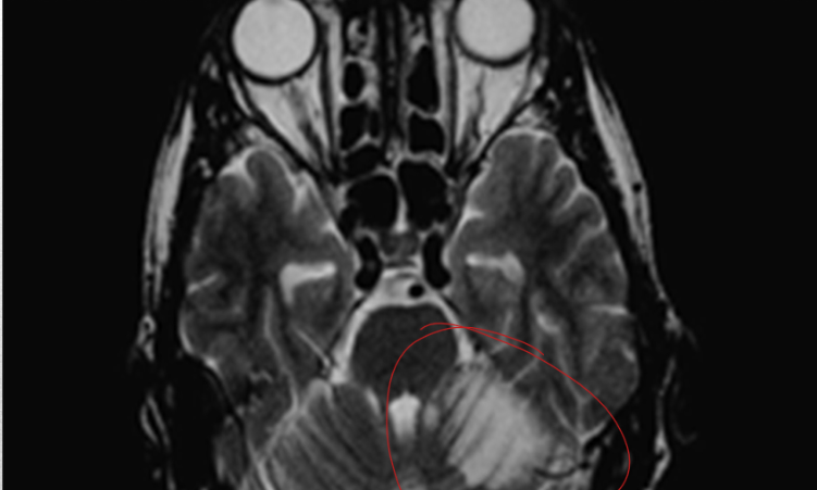 <p>this infarct may be clinically silent bc circulation is maintained by the other vertebral artery</p>