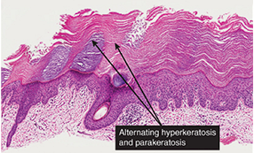 <ul><li><p><span style="color: red;">Precancerous lesion</span></p></li><li><p>Caused by sun exposure</p></li><li><p>Rough scaly lesion</p></li><li><p>Can progress to Squamous cell carcinoma</p></li></ul><p>Histology:</p><ul><li><p>Dysplastic keratinocytes</p></li><li><p><span style="color: red;"><strong>Parakeratosis:</strong></span> retention of nuclei in the stratum corneum</p></li></ul><ul><li><p>Thickened stratum corneum</p></li></ul><p></p>