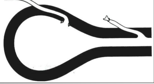 <p>What procedure for ectopic ureters refers to ligating and reattaching the ureter to the normal location on the bladder, adding additional submucosal tunneling of the ureter into the bladder wall proximal to the new opening?</p>