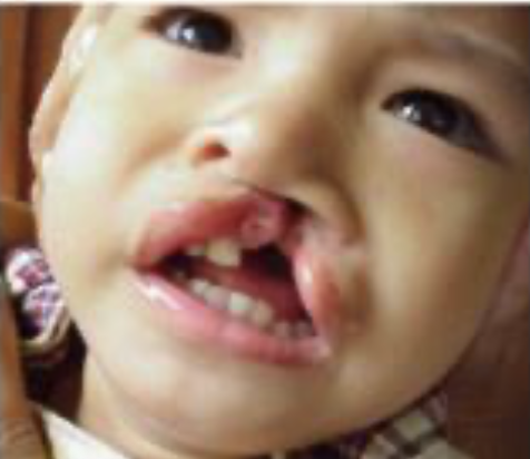 <p>Question #: 49 What is the classification of the cleft lip shown in the photo? <br>A. Unilateral Complete <br>B. Unilateral Incomplete <br>C. Bilateral Complete <br>D. Bilateral Incomplete</p>