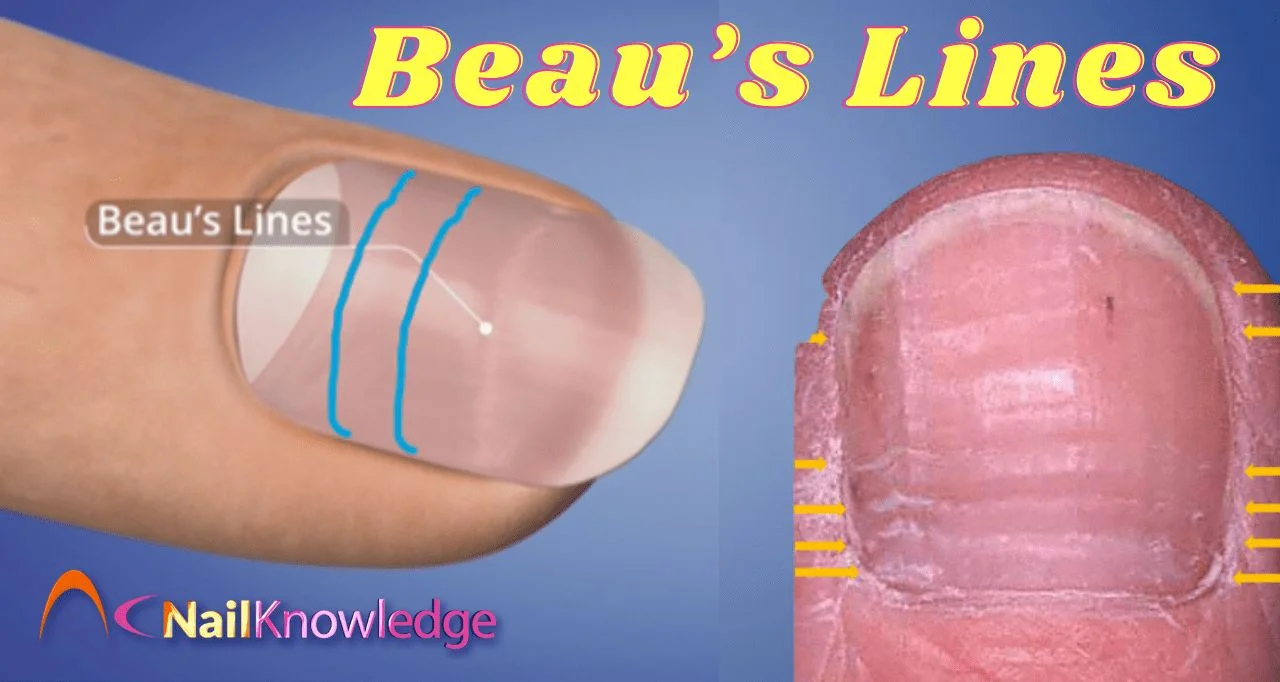 <p>Beau’s lines</p>