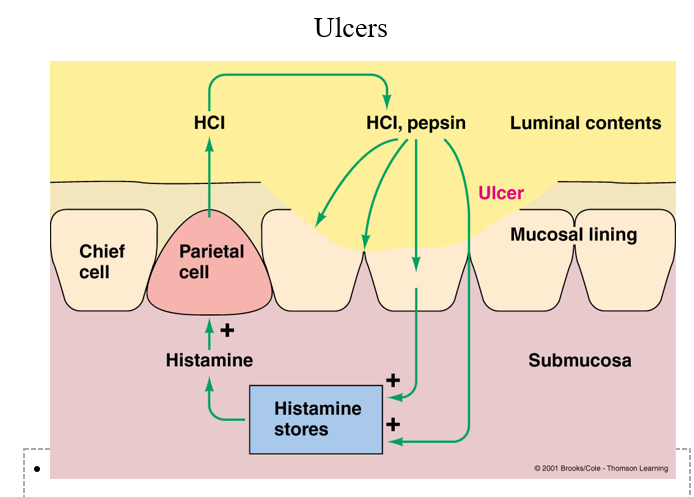 <p><span>1) Helicobacter pylori comes from contaminated water (drinking water with bugs in it).</span></p><p style="text-align: left;"><span>2) The bug burrows itself into the gastric mucosal barrier- grows and synthesizes proteins. </span></p><p style="text-align: left;"><span>3) Bug releases secretions (waste products)- they are irritants- irritate the membrane in the cells right under the mucosal layer- some secretions squeeze between cells and trigger mast cells in inflammatory response – these mast cells release histamine (local inflammatory response)</span></p><p style="text-align: left;"><span>4) Histamine is a potent stimulator of acid production in the parietal cells- this happens all the time, not just when there is food in the lumen (usually only releases acid when gastrin is triggered by food presence and distension of the stomach that triggers the ENS). Histamine stimulates parietal cells to produce acid all the time to the point the concentration of acid overwhelms the mucosal barrier, irritates and destroys and damages the cells- leads to more acid production and more damage ( a never-ending cycle) more inflammation, more histamine production.</span></p><p style="text-align: left;"></p><p style="text-align: left;"><span>Solution: Get rid of the bug, you get rid of the stimulus of this positive feedback loop (5-10 g penicillin-1 time treatment to get rid of the bug).</span></p>