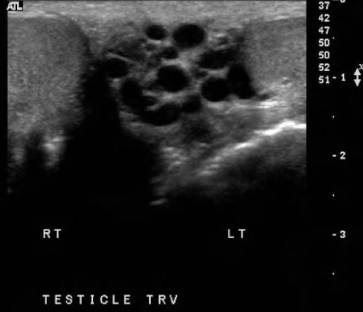 <p>it can be caused by nutcracker syndrome</p>