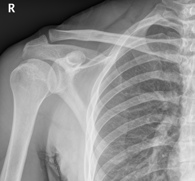 <p>clavical to sc joint, scapula to inferior border, proximal 1/3 humerus, lateral and superior soft tissue margins </p>