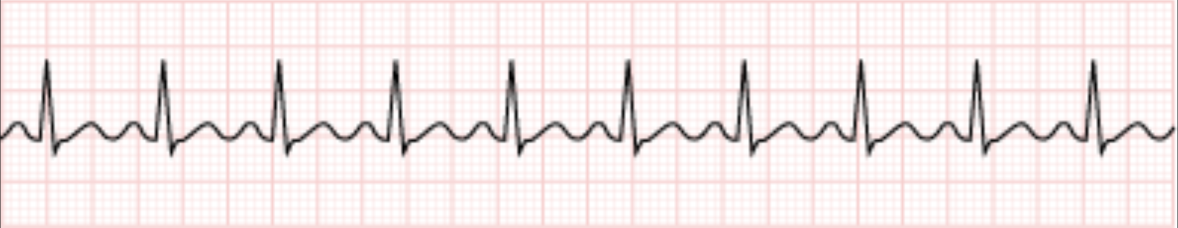 <p>Sinus tachycardia</p>