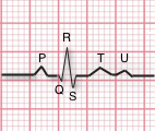<p><span>thought to represent repolarization of the Purkinje fibers; although this wave is rare, it sometimes appears in patients with hypokalemia (low potassium levels), hypertension, or heart disease </span></p>