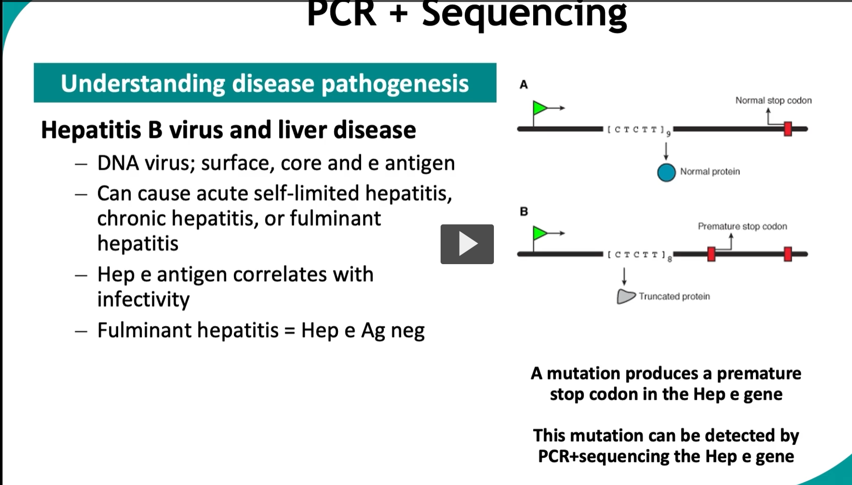 <p>This slide shows how <strong>PCR + sequencing</strong> helps us understand <strong>disease mechanisms (pathogenesis)</strong>—using <strong>Hepatitis B virus (HBV)</strong> as the example.</p><div data-type="horizontalRule"><hr></div><p> <span data-name="dna" data-type="emoji">🧬</span> Big Idea </p><figure data-type="blockquoteFigure"><div><blockquote><p><strong>A specific mutation in HBV changes a viral protein → changes disease behavior → detected by PCR + sequencing.</strong></p></blockquote><figcaption></figcaption></div></figure><p><span data-name="point_right" data-type="emoji">👉</span> This connects:<br><strong>genetic mutation → protein change → clinical outcome</strong></p><div data-type="horizontalRule"><hr></div><p> <span data-name="microbe" data-type="emoji">🦠</span> Part 1: Hepatitis B basics </p><ul><li><p>HBV is a <strong>DNA virus</strong></p></li><li><p>Produces key antigens:</p><ul><li><p><strong>Surface antigen (HBsAg)</strong></p></li><li><p><strong>Core antigen (HBcAg)</strong></p></li><li><p><strong>e antigen (HBeAg)</strong></p></li></ul></li></ul><div data-type="horizontalRule"><hr></div><p> <span data-name="key" data-type="emoji">🔑</span> Important concept: </p><figure data-type="blockquoteFigure"><div><blockquote><p><strong>HBeAg = marker of infectivity</strong></p></blockquote><figcaption></figcaption></div></figure><ul><li><p>If HBeAg is present → <strong>high viral replication / high infectivity</strong></p></li><li><p>If absent → usually lower infectivity… BUT not always (important!)</p></li></ul><div data-type="horizontalRule"><hr></div><p> <span data-name="warning" data-type="emoji">⚠</span> Disease outcomes </p><p>HBV infection can cause:</p><ul><li><p><strong>Acute hepatitis</strong> (self-limited)</p></li><li><p><strong>Chronic hepatitis</strong></p></li><li><p><strong>Fulminant hepatitis</strong> (severe, rapid liver failure)</p></li></ul><div data-type="horizontalRule"><hr></div><p> <span data-name="dna" data-type="emoji">🧬</span> Part 2: The mutation (right side diagram) Normal case (A) </p><ul><li><p>Gene has a <strong>normal stop codon at the correct position</strong></p></li><li><p>Full protein is made → <strong>functional HBeAg</strong></p></li></ul><p><span data-name="point_right" data-type="emoji">👉</span> Result:</p><ul><li><p>Virus produces HBeAg</p></li><li><p>Infection is detectable via this marker</p></li></ul><div data-type="horizontalRule"><hr></div><p> Mutant case (B) </p><ul><li><p>A <strong>point mutation introduces a premature stop codon</strong></p></li></ul><p><span data-name="point_right" data-type="emoji">👉</span> What happens:</p><ul><li><p>Protein production stops early</p></li><li><p><strong>Truncated (shortened) protein</strong> is made</p></li><li><p>HBeAg is <strong>NOT produced</strong></p></li></ul><div data-type="horizontalRule"><hr></div><p> <span data-name="fire" data-type="emoji">🔥</span> Critical clinical insight </p><figure data-type="blockquoteFigure"><div><blockquote><p><strong>Fulminant hepatitis = HBeAg negative</strong></p></blockquote><figcaption></figcaption></div></figure><p>BUT:</p><ul><li><p>Virus is still active</p></li><li><p>Just not producing detectable HBeAg</p></li></ul><p><span data-name="point_right" data-type="emoji">👉</span> This can be misleading clinically</p><div data-type="horizontalRule"><hr></div><p> <span data-name="brain" data-type="emoji">🧠</span> Why this matters </p><ul><li><p>Patient appears:</p><ul><li><p>HBeAg negative</p></li></ul></li><li><p>But actually:</p><ul><li><p><strong>Still highly infected and dangerous</strong></p></li></ul></li></ul><p><span data-name="point_right" data-type="emoji">👉</span> This mutation explains:</p><figure data-type="blockquoteFigure"><div><blockquote><p>Why some severe HBV cases lack HBeAg</p></blockquote><figcaption></figcaption></div></figure><div data-type="horizontalRule"><hr></div><p> <span data-name="test_tube" data-type="emoji">🧪</span> How we detect this (PCR + sequencing) Step 1: PCR </p><ul><li><p>Amplify the <strong>HBe gene</strong></p></li></ul><div data-type="horizontalRule"><hr></div><p> Step 2: Sequencing </p><ul><li><p>Read the DNA sequence</p></li><li><p>Identify:</p><ul><li><p><strong>mutation causing premature stop codon</strong></p></li></ul></li></ul><div data-type="horizontalRule"><hr></div><p> Result: </p><ul><li><p>Detect <strong>hidden mutant virus</strong></p></li></ul><div data-type="horizontalRule"><hr></div><p> <span data-name="jigsaw" data-type="emoji">🧩</span> Conceptual connection </p><table style="min-width: 50px;"><colgroup><col style="min-width: 25px;"><col style="min-width: 25px;"></colgroup><tbody><tr><th colspan="1" rowspan="1"><p>Level</p></th><th colspan="1" rowspan="1"><p>What happens</p></th></tr><tr><td colspan="1" rowspan="1"><p>DNA</p></td><td colspan="1" rowspan="1"><p>mutation (point mutation)</p></td></tr><tr><td colspan="1" rowspan="1"><p>Protein</p></td><td colspan="1" rowspan="1"><p>truncated HBeAg</p></td></tr><tr><td colspan="1" rowspan="1"><p>Lab test</p></td><td colspan="1" rowspan="1"><p>HBeAg negative</p></td></tr><tr><td colspan="1" rowspan="1"><p>Clinical effect</p></td><td colspan="1" rowspan="1"><p>severe disease (fulminant hepatitis)</p></td></tr></tbody></table><div data-type="horizontalRule"><hr></div><p> <span data-name="fire" data-type="emoji">🔥</span> High-yield summary </p><figure data-type="blockquoteFigure"><div><blockquote><p>A mutation in the HBV Hep e gene creates a premature stop codon, preventing HBeAg production and leading to severe disease; this mutation can be detected by PCR and DNA sequencing.</p></blockquote><figcaption></figcaption></div></figure><div data-type="horizontalRule"><hr></div><p> <span data-name="brain" data-type="emoji">🧠</span> Simple mental model </p><ul><li><p>Normal gene → full protein → detectable marker</p></li><li><p>Mutated gene → early stop → no marker → hidden but dangerous infection</p></li></ul><div data-type="horizontalRule"><hr></div><p> <span data-name="warning" data-type="emoji">⚠</span> Exam tip (VERY important) </p><figure data-type="blockquoteFigure"><div><blockquote><p><strong>HBeAg negative does NOT always mean low infectivity</strong><br>→ Could be a <strong>pre-core mutant HBV</strong></p></blockquote><figcaption></figcaption></div></figure><p></p>