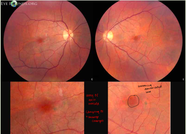 <p>macula: absence of foveal reflex with pigment clumping OU</p><p>strange changes in macula </p><p>was told pt had aging changes; but our pt is 47 (too young for AMD)</p>