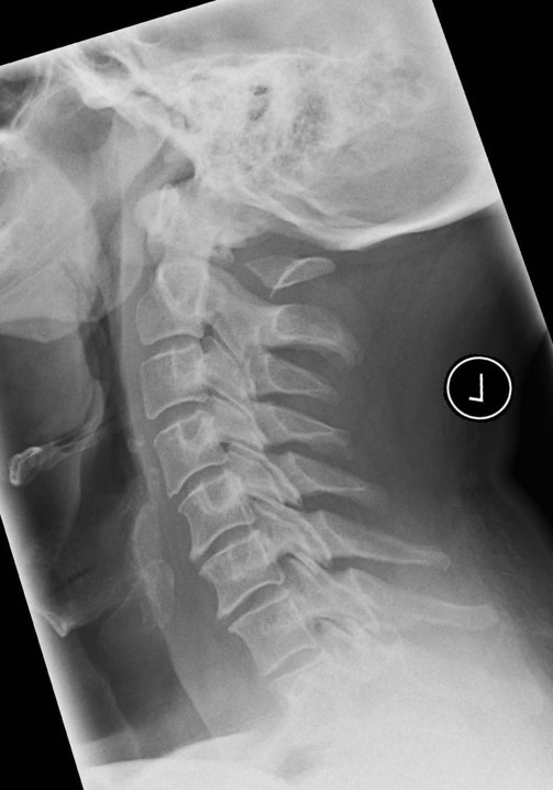 <p>Neck pain following a MVA. What is the diagnosis?</p>
