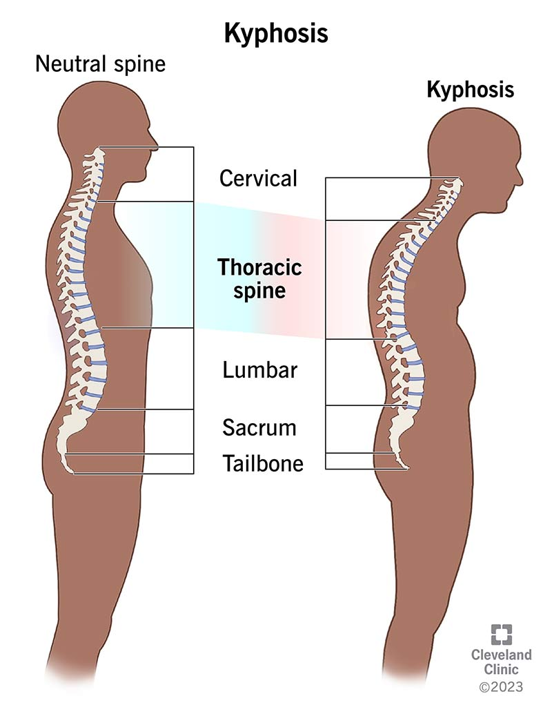 <p>What Spinal Curvuture?</p>