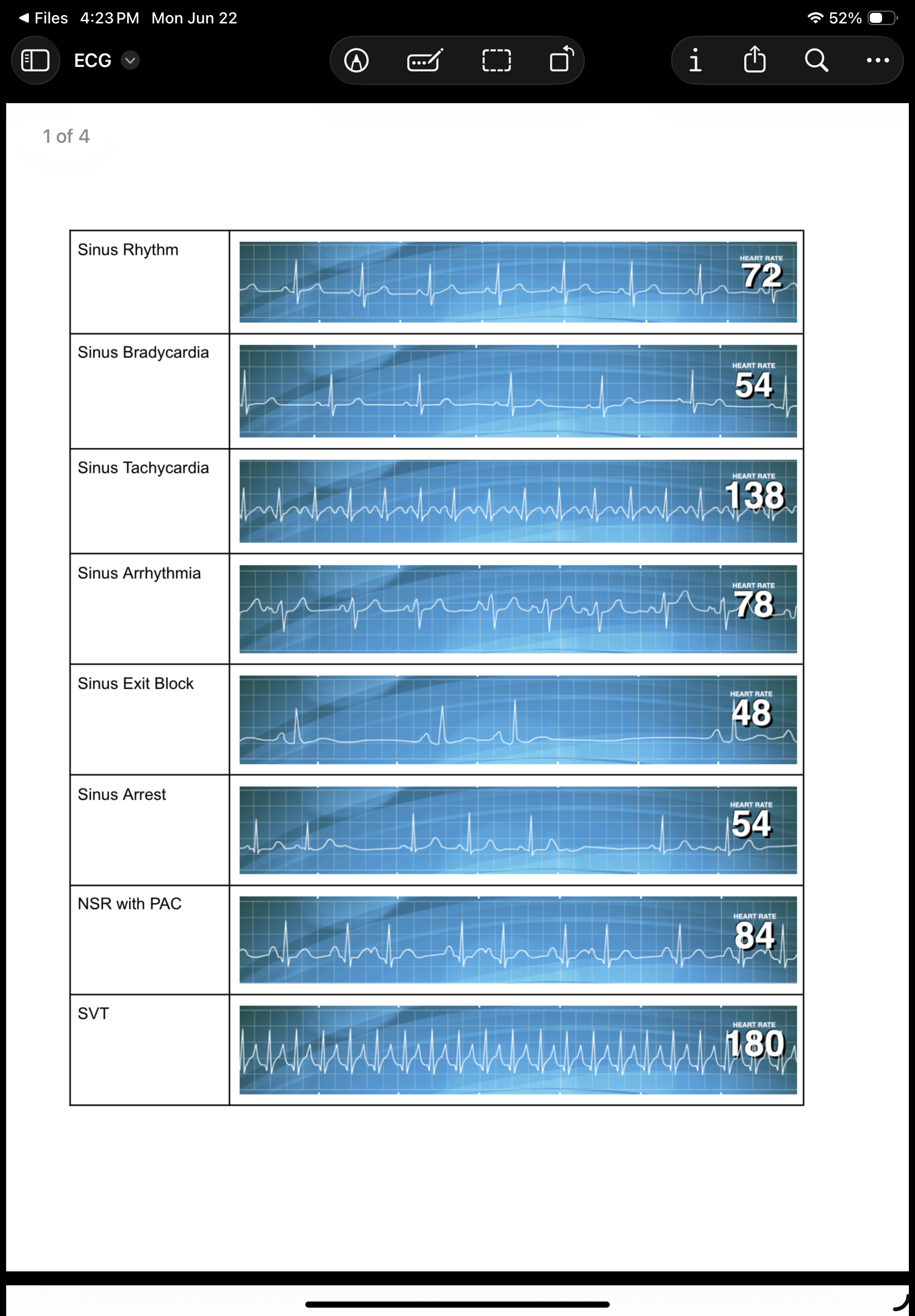 <p>A normal heart rhythm originated from the sinus node.</p>