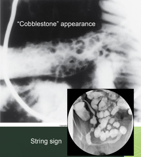 <p>Idiopathic, chronic, inflammatory disorder involving any part of the gastrointestinal tract but commonly involving the terminal ileum.</p>