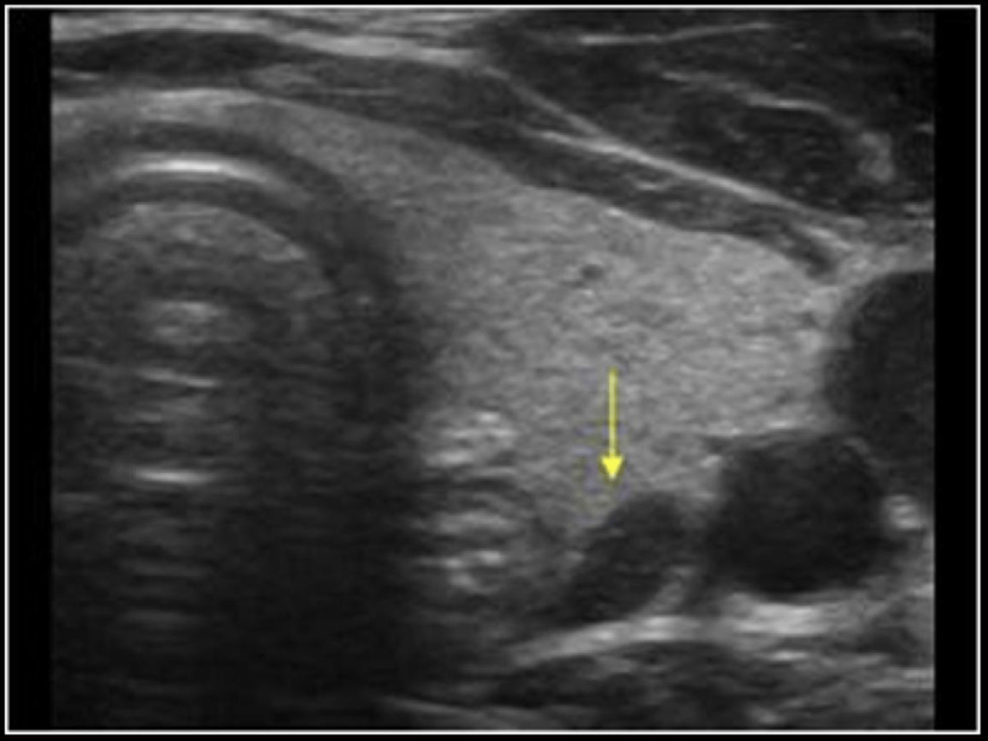 <p>parathyroid adenoma</p>