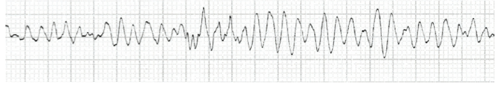 <p> Ventricular Fibrillation (V-Fib)</p><p>Definition:</p><p>Chaotic, disorganized ventricular electrical activity with no effective contraction.</p><p>ECG features:</p><p>No identifiable P waves, QRS complexes, or T waves. Random, irregular, chaotic electrical oscillations.</p>