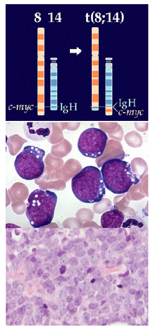 <p>Burkitt Lymphoma</p>