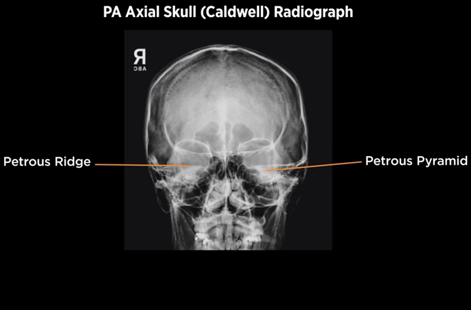 <p>PA Axial Skull (Caldwell)</p>