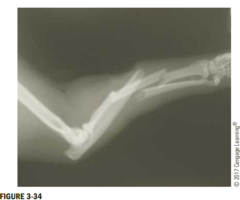 <p>radius and ulna</p>