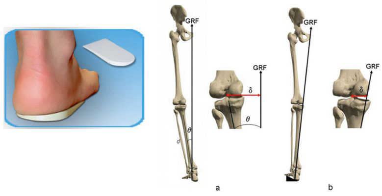<p></p><ul><li><p>Lateral heel wedge causes <strong>eversion at the rearfoot</strong> </p></li><li><p>Due to their being increased eversion, this causes <strong>increased pronation</strong> </p></li><li><p>This eversion and increased pronation causes an <strong>increased valgus moment</strong> (medial collapse)</p></li><li><p>This overall helps to decrease pain and changes the location of the GRF</p></li></ul><p></p>