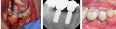 <p>What is the ideal treatment for peri-implant health but a soft tissue deficiency?</p>