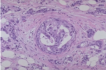 <p>How would you grade this infiltrative ductal carcinoma?</p>