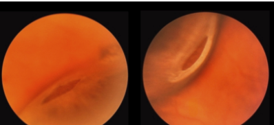 <ul><li><p>Crater: more moth-eaten, not distinct borders, RPE is not fully present</p></li><li><p>Atrophic hole: all 9 retinal layers completely missing → looking directly at the RPE</p></li></ul><p></p>
