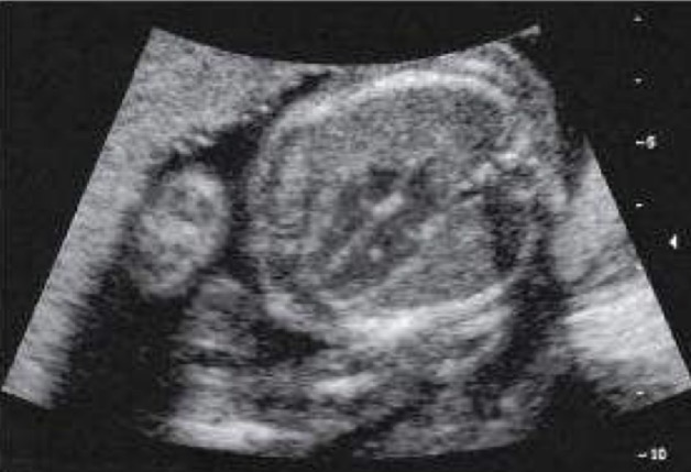 <p><u>Lemon Sign</u>: appears as bilateral, frontal, concave scalloping of calvaria</p><p><u>Prominent Cisterna Magna</u>: in absence of another malformation, this is normal finding</p><p><u>Choroid Plexus Cyst</u>: in absence of other malformation, this is normal finding that usually resolves by 24-26 gestational weeks</p><p><u>Cavum Vergae</u>: normal prominent posterior continuation of cavum septum pellucidi, which may simulate a dilated 3rd ventricle or arachnoid cyst</p><p><u>Fetal Hair</u>: commonly seen in 3rd trimester and should not be mistaken for calverial mass or scalp edema</p><p><u>Prominent Cardiac Moderator Band</u>: normal enlargement or prominence of moderator band can simulate ventricular thrombus or neoplasm</p><p><u>Echogenic Intracardiac Focus (EIF)</u>: seen as small bright echo focus in the heart on a 4-chamber heart view; if EIF is seen in isolation in a normal pregnancy, it is considered a normal benign variant; EIF’s are seen in 4-5% of normal pregnancies (what is shown in image)</p>