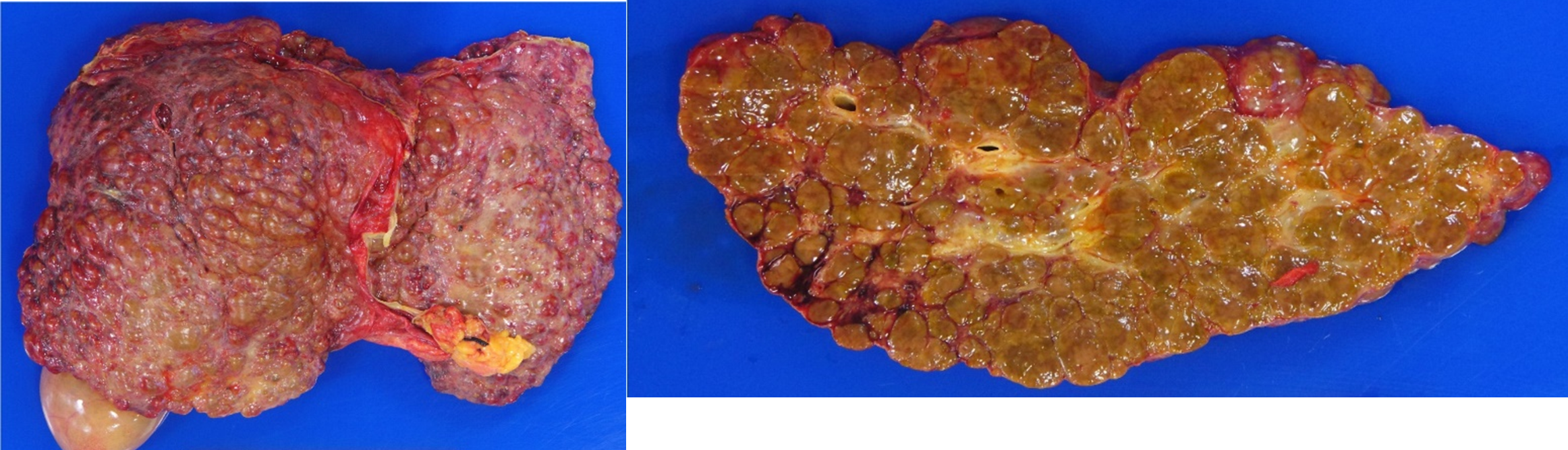 <p>patologinis procesas</p>