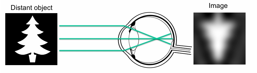 <p>Short sightedness </p><p>• The myopic eye has too much focal power for its length</p><p> • Light rays converge (are focused) in front of the retina </p><p>• The image at the retina is blurred (out of focus) Image . . </p><p>• Remember that distant objects are focused closer to the lens - A myopic eye will not be able to focus on distant objects, but can focus on objects at a short distance.</p>
