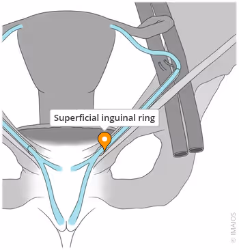 <ul><li><p>The end of the inguinal canal</p></li><li><p>Opening in the aponeurosis of the external oblique</p></li></ul><p></p>