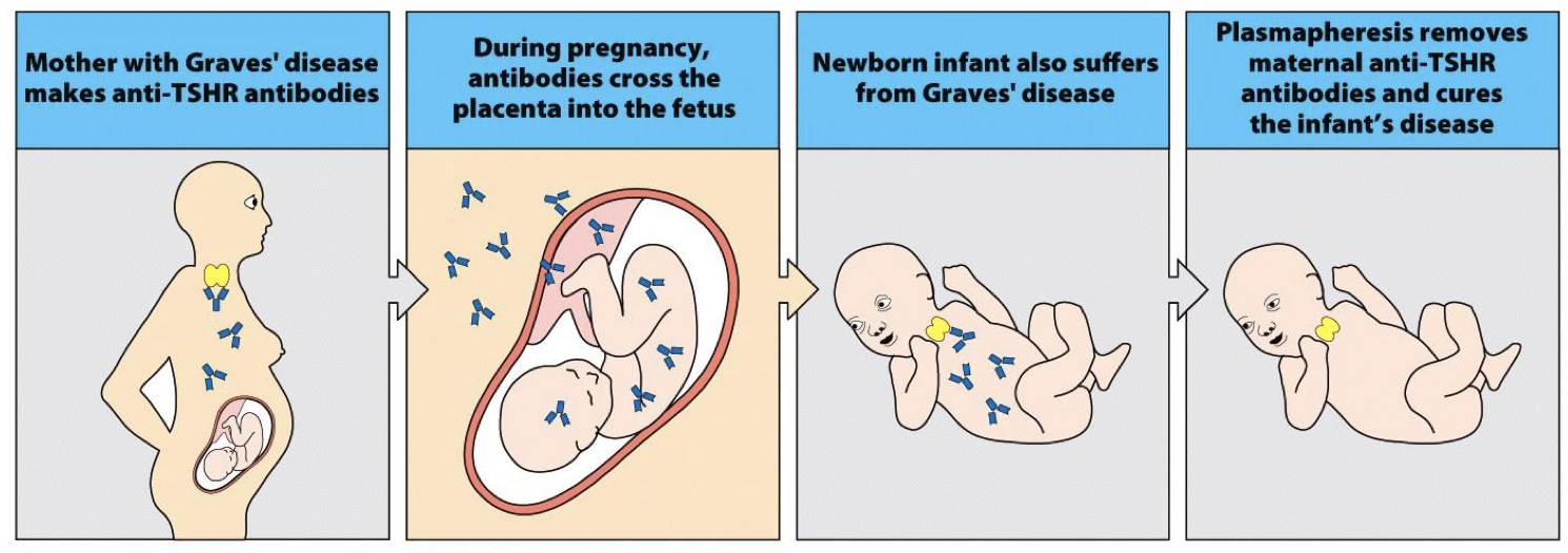<p>those with AI diseases are healthy for a long time but once tissue destruction begins, its damage has become irreversible by the time of diagnosis and we become unsure if damage was from disease or cause of disease →</p><p><strong>-but we learned from AI that pregnant women with AI pass auto-IgG  and anti TSHR</strong> to baby → <strong>baby born with autoimmnune disease will exhibit symptoms till 6 months (when mothers Ab degrades and produces own Ab) and baby will be symptom free</strong> →lymphocytes can’t cross placenta, telling us this was an autoimmune disease</p>