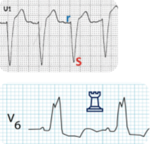<p>rS em V1</p><p>Formato M na onda R em V6—>Torre</p>
