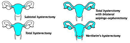 <p>Wertheim Radical Hysterectomy</p>
