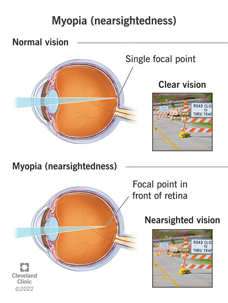 <p>PP: eye grows too deep/far back into skull</p><p>RF: glaucoma<br>retina detachments<br>cataracts<br>macular degeneration<br>legal blindness</p><p>E: m/c→worldwide epidemic</p><p>CM: near→clear vision<br>far→blurry vision</p><p>TX: glasses(no lenses)<br>contact lenses<br>myopia management</p>