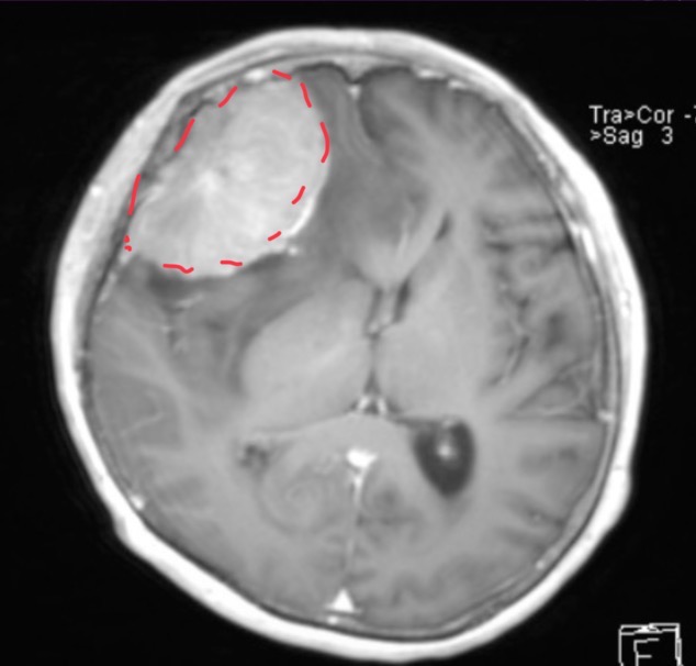 <p>55 year-old male is following up with neurosurgery for a pre op scan</p>
