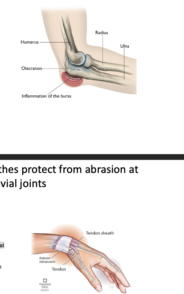 <p>*Protects against ‘banging up’ of highly movable joints (because synovial joints are mobility as tradeoff for stability)</p><p></p><p>1. Bursa:</p><ul><li><p class="p2">Connective tissue sac containing synovial fluid</p></li><li><p class="p2">Provides padding and reduces friction between two structures that rub at a synovial joint</p></li></ul><p class="p2"></p><p class="p2">Clinical problems: Bursitis (inflammation)</p><p></p><p>2. Tendon Sheathes:</p><ul><li><p class="p2">Connective tissue sac containing synovial fluid</p></li><li><p class="p2">Wraps around tendon at area of abrasion (so tendons don’t rub up on each other - > inflammation)</p></li><li><p class="p2">Clinical problems: Tendinitis and Tenosynovitis</p></li></ul><p></p>