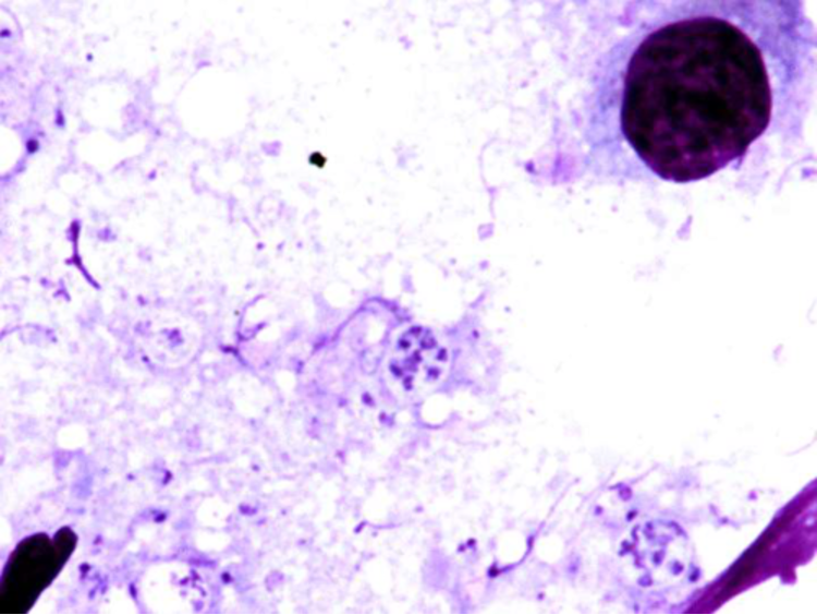 <p><span>Bronchial alveolar lavage,  Giemsa stain</span></p>