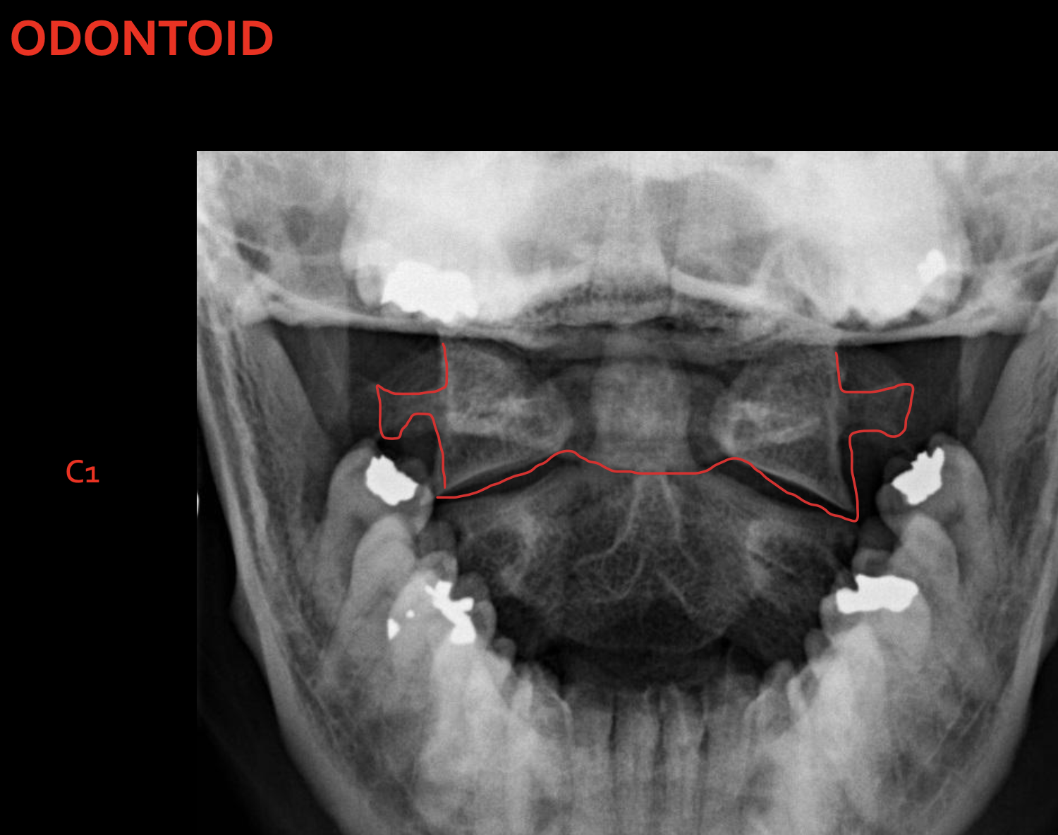 <p> <span>Odontoid process </span>C1 </p>