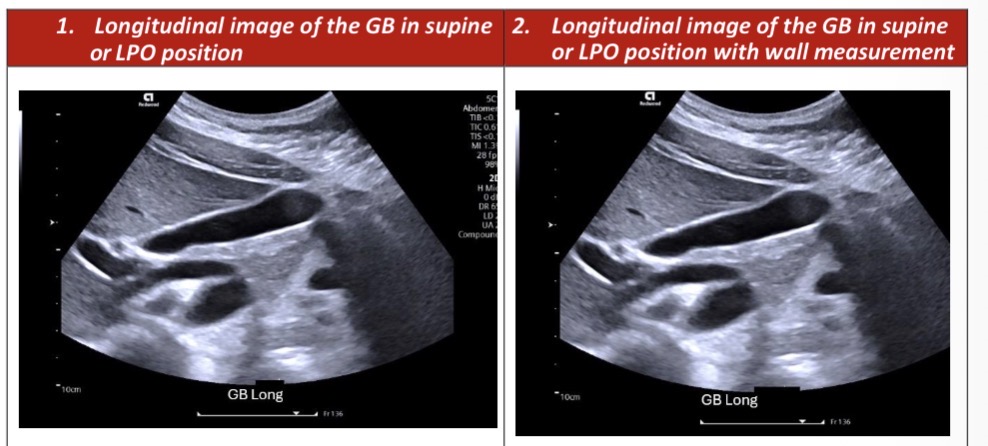 <p>Patient in LPO position with their left side down.</p><p>Locate the gallbladder in the transverse plane by placing your probe in the RUQ about midway between the xiphisternum and lower costal magrin.</p><p>Slide / angle the transducer superiorly and inferiorly through the right lobe of the liver until you find it. </p><p>Use deep suspended inspiration. </p><p>Once the GB is located rotate your transducer to elongate it out to its longest length, this will be the longtudinal plane. </p><p>To survey the GB begin begin by sweeping laterally until clear of the GB by about 2 cm. Then sweep medially until Lear of the GB by about 2 cm, and return to the starting position on the lateral side of the GB assessing the contour and symmetry of the walls. </p><p></p>